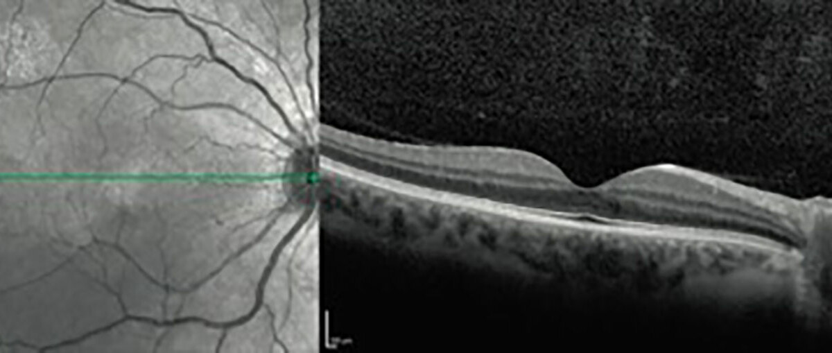 OCT - Optische Cohärenz-Tomographie